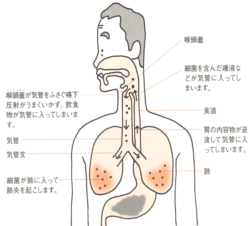 誤嚥性肺炎について